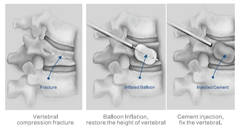 Vertebral Body Puncture Needle Bone Cement Balloon Catheter Percutaneous Vertebroplasty Instrument Set